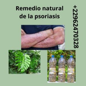 Té 085: Psoriasis, remedio natural