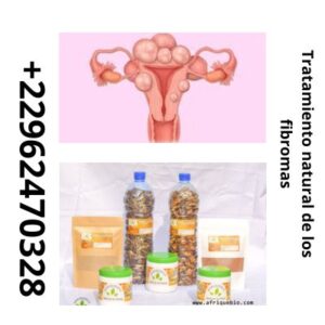 Curar Fibromas, Miomas: Tratamiento 100 % natural de los fibromas
