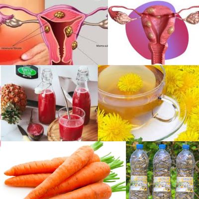 Entender los miomas, Fibromas uterinos: Tratamiento natural