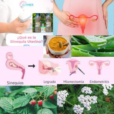 1.Entender la sinequia uterina: Tratamiento natural