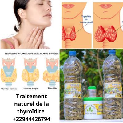 ¿Cómo tratar la tiroiditis? Tratamiento natural para la tiroiditis